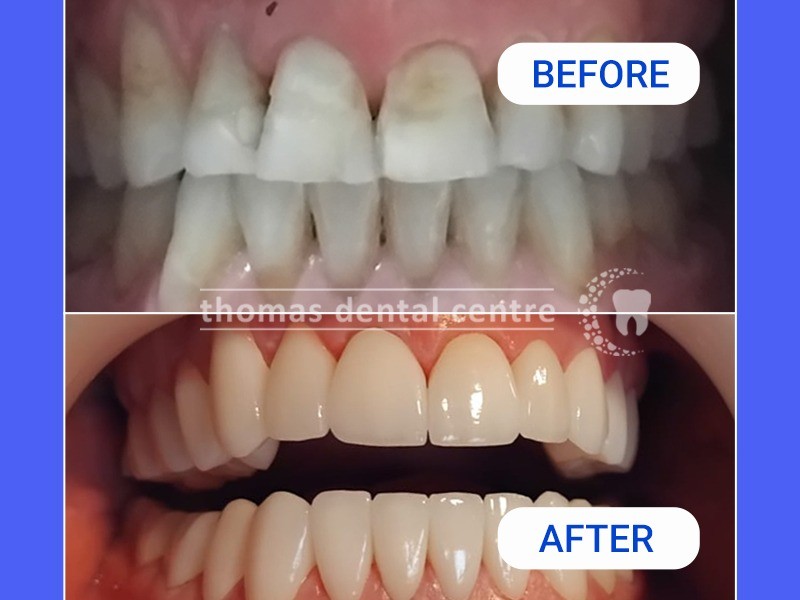 before and after