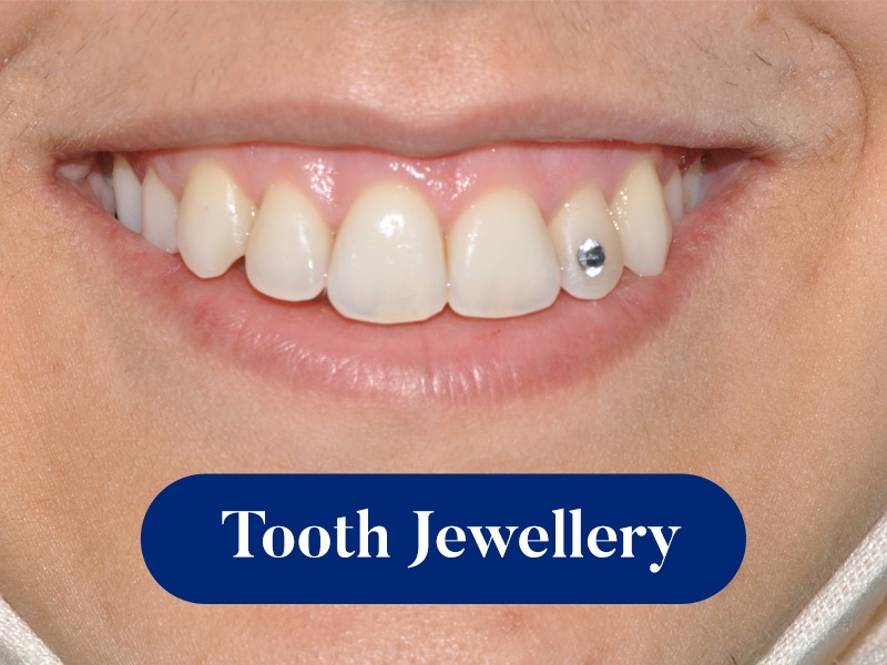 Teeth Jewel