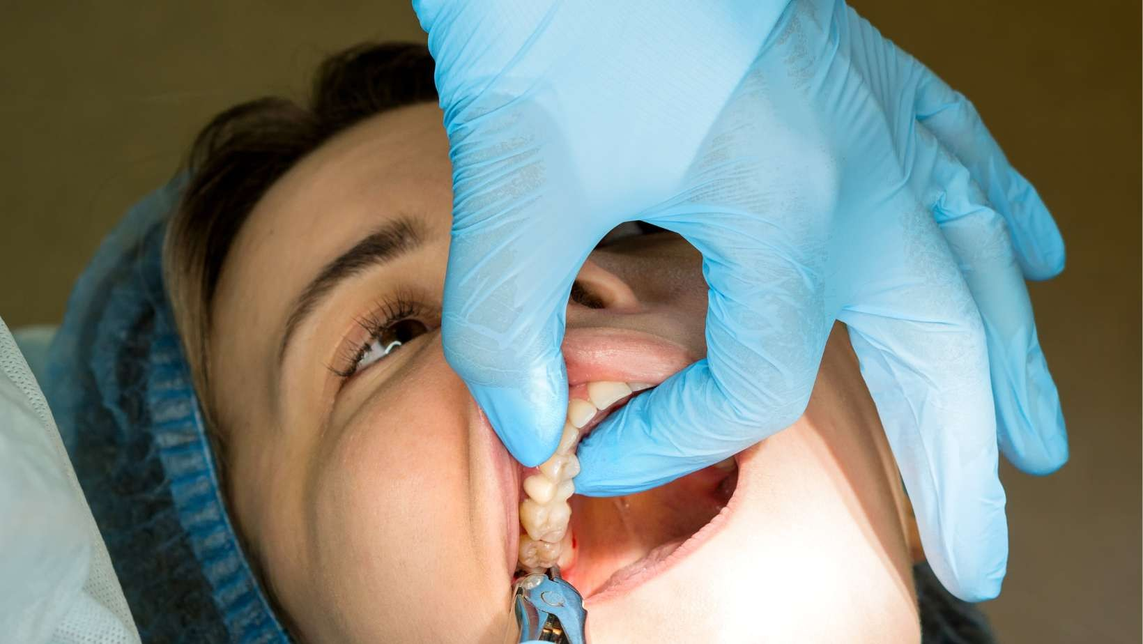 Tooth Extraction