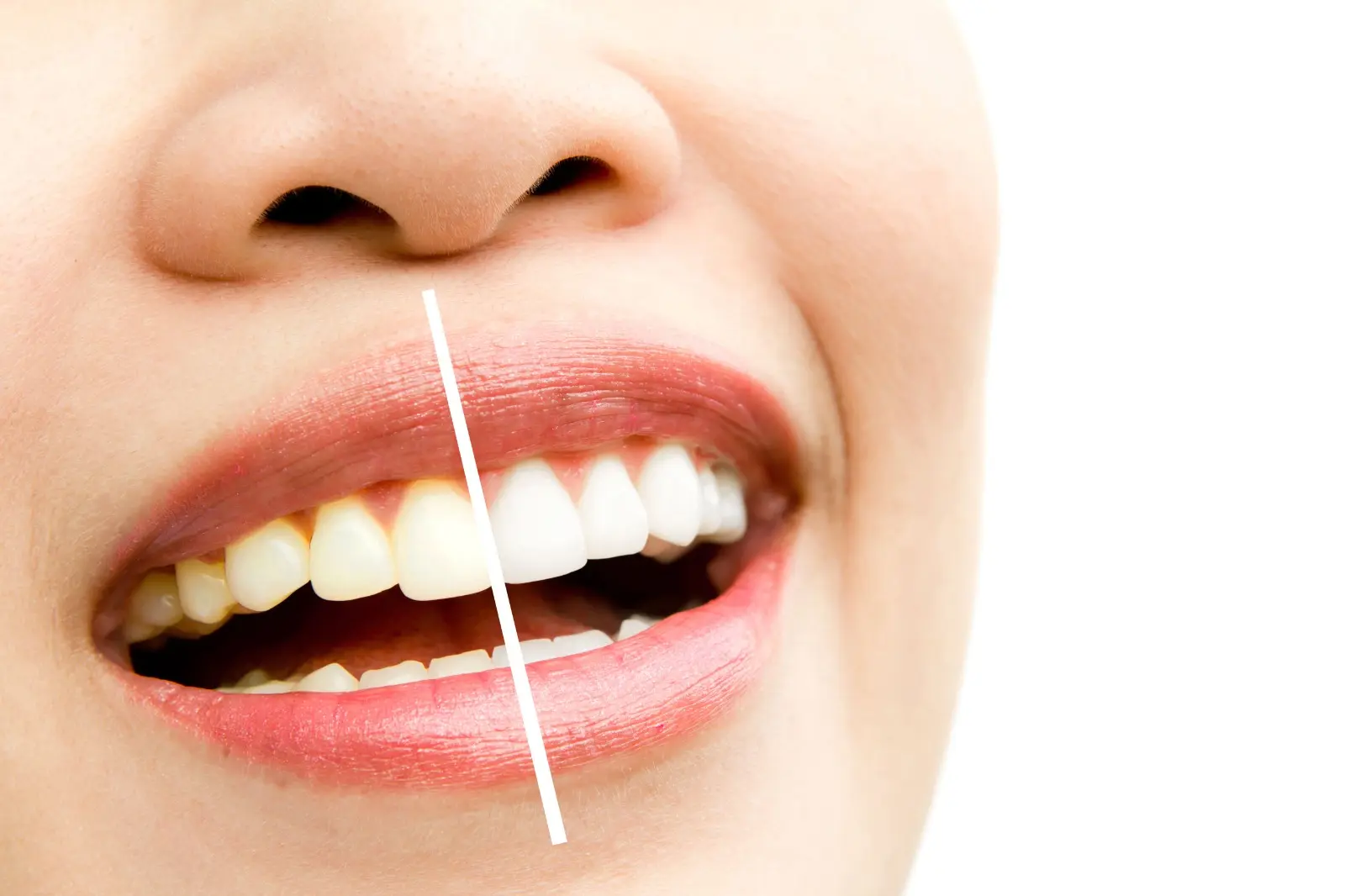 5 Facts About Teeth Whitening You Should Know