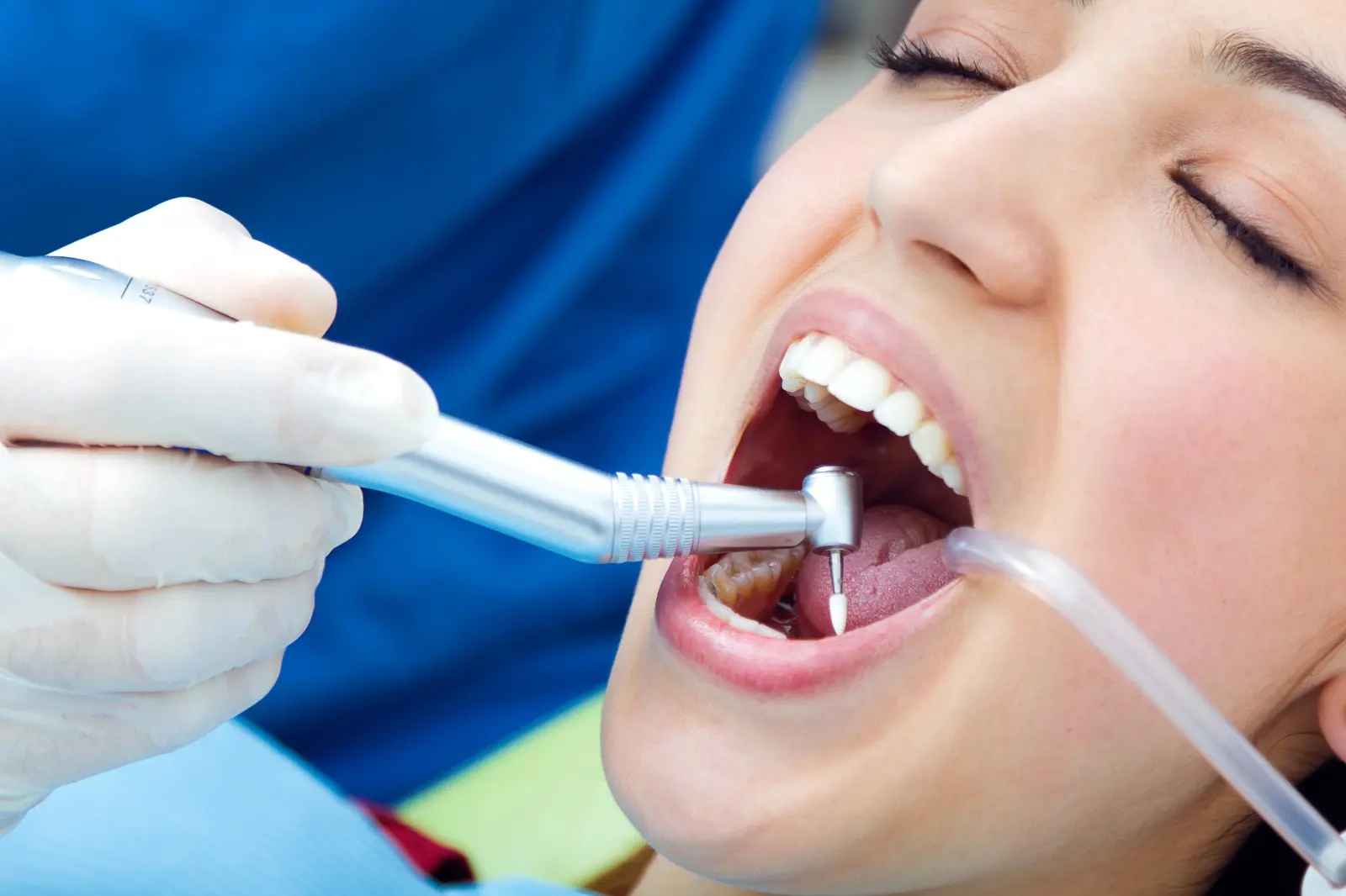 Deep Cleaning Teeth in Abu Dhabi | Thomas Dental Centre Guide