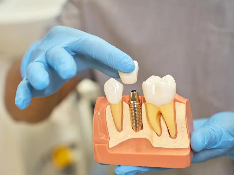Top 5 Things to Know Before Getting Dental Implants in Abu Dhabi