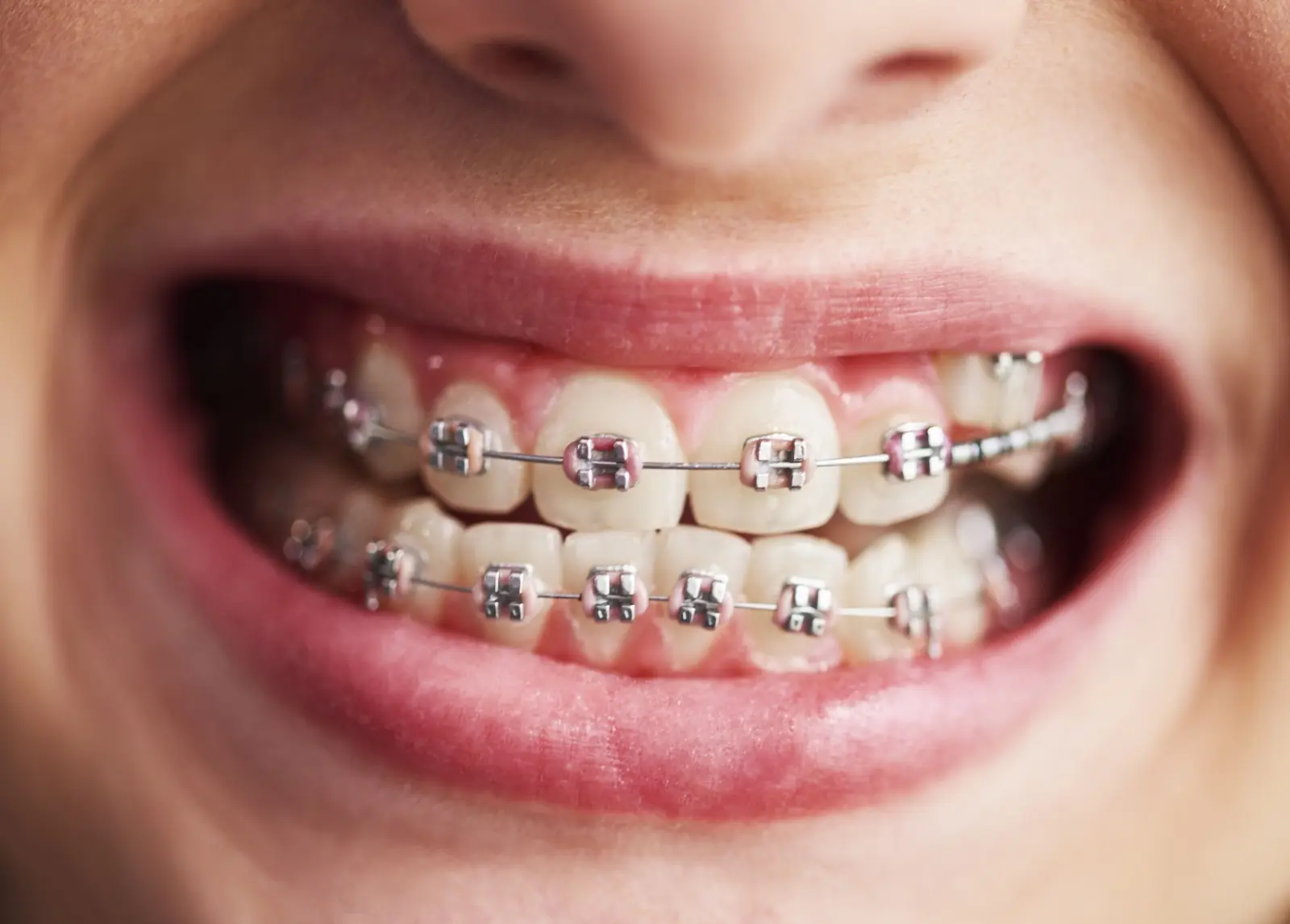 The Different Types of Braces: Which One is Right for You