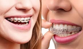 Clear Aligners vs Braces in Abu Dhabi: Which Suits You