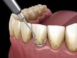Gum Health Matters & Gum Disease Signs